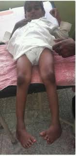 Approximately 50% of cases of clubfoot affect both feet. Neglected Bilateral Clubfoot Physiopedia