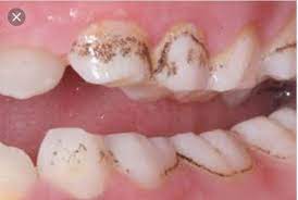 Teeth whitening products are not necessarily quite what they seem.you may think that they are whitening your teeth, when in reality they are just removing st. Can I Just Scrape Off The Brown Spots On My Front Teeth With A Pin As There Is No Other Way To Remove Them Permanently Photo