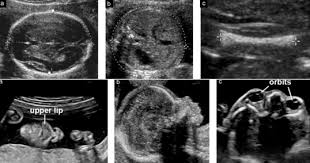 Best Anomaly Scan Center In Chennai