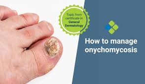 Image result for onychomycosis