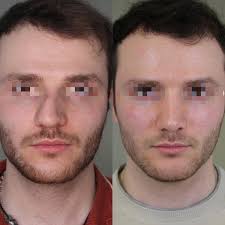 Dr. Milos Kovacevic Nasenkorrektur-Nasennachkorrektur Hamburg  (@dr.miloskovacevic) · Hamburg-Mitte