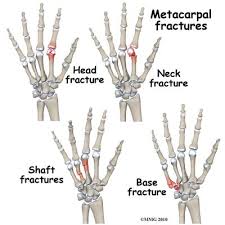 Metacarpal Fractures Fractures Neck Fracture Fracture Symptoms