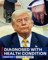 U.S. President Donald Trump has been diagnosed with chronic venous  insufficiency after undergoing a "comprehensive examination" for swelling  in his legs. The condition is considered common, particularly in people  over 70, and