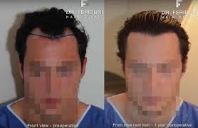 Jun 24, 2012 · the ugly truth about dating an older man. Hair Transplant Of The Receding Hairline Hairforlife