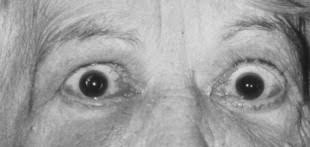 Palpebral Fissure An Overview Sciencedirect Topics