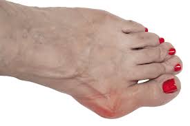 Image result for gout