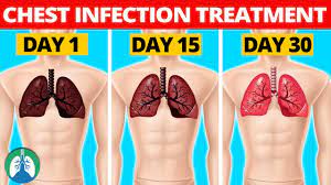 Mucus, also called sputum or phlegm, is produced by the airways as a defense against infections or irritants. 7 Natural Chest Infection Treatments Home Remedies Youtube