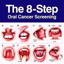 Inability to chew properly 9. Mouth Cancer Archives Overland Park Dentistry