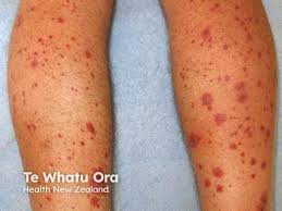 Image result for Vasculitis