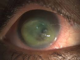 Primary infection typically presents as swelling of the conjunctiva and eyelids (blepharoconjunctivitis), accompanied by small white itchy lesions on th. Bilateral Herpes Simplex Keratitis Lactation A Trigger For Recurrence Bmj Case Reports