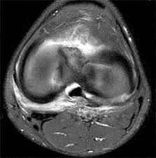 Naturally, in order to assess pathologic knee imaging, it is necessary to know the appearance of a normal knee mri. Posteromedial Corner Injury Of The Knee Radsource