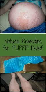 All you need to do is use the medicines prescribed by the doctor and relax your nerves to control the itching and discomfort. Natural Remedies For Puppp Relief How We Flourish