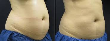 We did not find results for: Vancouver Coolsculpting Surrey Coolsculpting Delta Langley White Rock