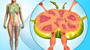 Swollen lymph nodes refer to enlargement of one or more lymph nodes in the body. Do Enlarged Lymph Nodes Offer Clues About Cancer
