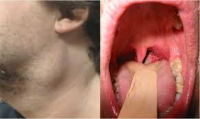 Adesea există o umflătură vizibilă și roșeață în proiecția directă a glandei salivare inflamate. Cancer De Orofaringe Sintomas Hpv Gorge Traitement