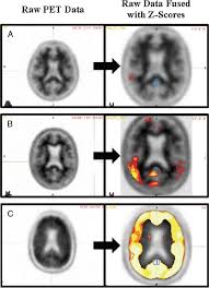 Maybe you would like to learn more about one of these? Example Florbetapir Pet Scan Images A Images From A Normal Scan Download Scientific Diagram
