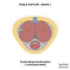 Buck's fascia (deep fascia of the penis, gallaudet's fascia or fascia of the penis) is a layer of deep fascia covering the three erectile bodies of the penis. Penile Fracture Grading Radiology Reference Article Radiopaedia Org