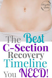 C Section Recovery Timeline Forgotten Lattes C Section Recovery Timeline C Section Recovery C Section