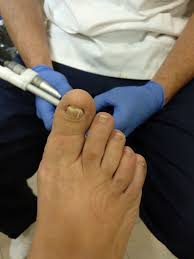 En otros casos la infección por hongos puede extenderse a la piel que rodea las uñas y a otras zonas del pie (micosis). Reconstruccion Estetica De La Una Podologo En Jerez