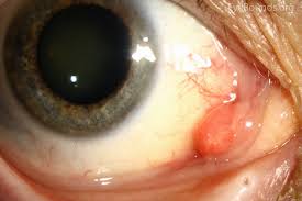 Image result for lesion sclera