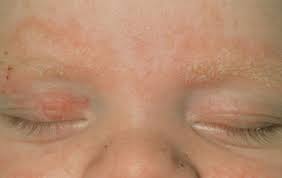 Image result for yellow scabs on the face in children