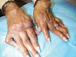 Rheumatoid Arthritis Including Sjogren S Syndrome Musculoskeletal Key