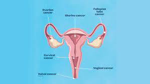 Test low high unit results. What Is Gynaecological Cancer And What Are The Symptoms Queensland Health