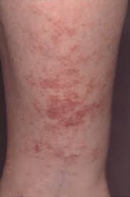 Check spelling or type a new query. Exercise Induced Vasculitis Ramelet 2006 Journal Of The European Academy Of Dermatology And Venereology Wiley Online Library