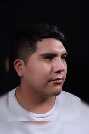 ✨RINOPLASTIA ULTRASÓNICA DE RÁPIDA RECUPERACIÓN ✨Para acceder a una cita  presencial o virtual:✅📲 Citas al Whatsapp: 998 471 613:  https://bit.ly/36flGiU👩‍⚕Dra. Karen Valverde