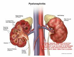 Image result for Acute Pyelonephritis