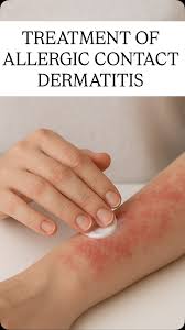Image result for contact dermatitis