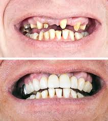 Does a maryland bridge damage your teeth? Dental Bridge Procedure Dental Bridge Vs Dental Implant