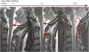 A psychotherapist can use talk therapy to treat anxiety, depression, sexual dysfunction, and other emotional or behavioral issues from coping with transverse myelitis. Evolution Of Longitudinally Extensive Transverse Myelitis In An Aquaporin 4 Igg Positive Patient Neurology