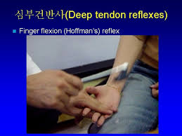Hoffman sign, hoffman reflex, hoffman's reflex. 1 History Taking 2 Mental Status Examination 3