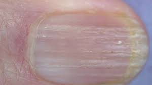 Maybe you would like to learn more about one of these? Ridges In Fingernails Symptoms Causes And Treatments