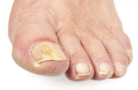 Image result for mykoza nehtů