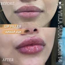 فيلر شفايف بعيادتنا د/مها سليمان ‏‎نرحب بكل استفسارتكم عن طريق رسائل  الدايركت و الواتس اب او بالاتصال ‎📱 : 90020300