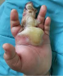 Injury or infection to a finger or fingers is a common problem. Patient Presenting With Left Middle Finger Infection With Abscess Download Scientific Diagram