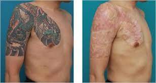 We still recommend the laser tattoo removal method. Risks Of Non Laser Tattoo Removal Methods Like Acid Tattoo Removal