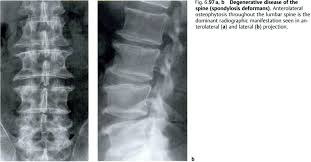 Bone And Joint Disorders Degenerative Disease Bone And Joint Medical Imaging