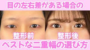 目の左右非対称を治すにはどうする？ベストな二重幅の選び方を伝授！ - 池袋東口院