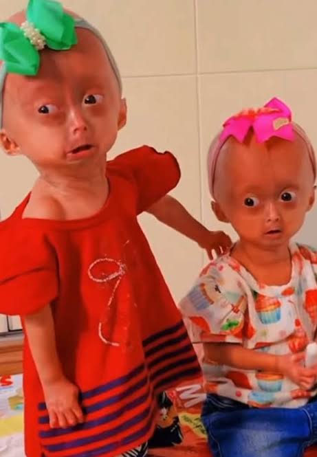 Elis and Eloa play and sing 🎶 #eliseeloa #progeria #toddler #twin #f... |  TikTok