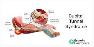 The ulnar nerve is responsible for the sensation that you get when you. Cubital Tunnel Syndrome How You Re Unknowingly Damaging Your Nerves Esports Healthcare