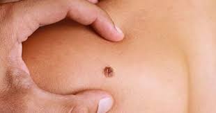 في البداية المالية وتد هل الورم السرطاني صلب guillotinpoilvet com