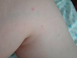 Image result for bedbugs bites