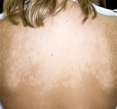 These white spots stand out very prominently after tanning because the surrounding area becomes darker. Why Won T My Skin Tan Music City Moms