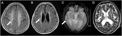 Moderate To Severe Obstructive Sleep Apnea Is Associated With Cerebral Small Vessel Disease Sciencedirect