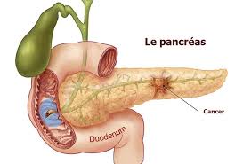 Maybe you would like to learn more about one of these? Cancer Du Pancreas Symptomes Et Traitement