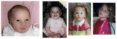 Myhre Syndrome Medlineplus Genetics