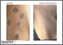 A botched relationship, bad tattoo art and wrong choices can leave you up in arms with your tattoo. Can Tattoos Be Removed Completely